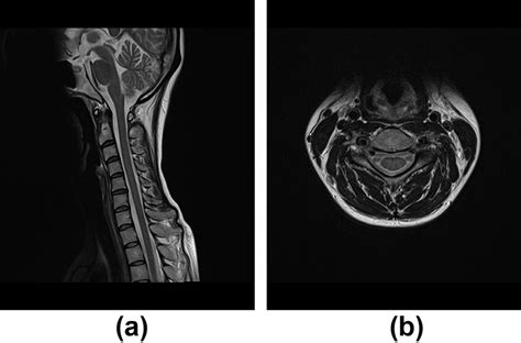 Cervical Magnetic Resonance Imaging Mri 11 Days After Treatment