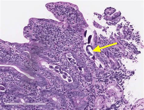 Strongyloides stercoralis is identified within the crypts of the ...