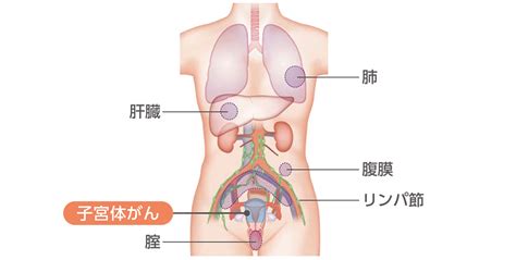 転移と再発とは 子宮体がん Msd Oncology がんを生きる