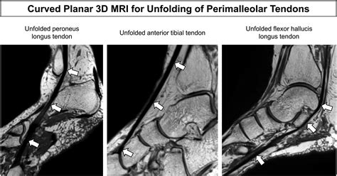 Multiaxial 3d Mri Of The Ankle Foot And Ankle Clinics