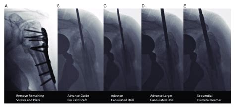 Intraoperative Fluoroscopy Images Of Surgical Technique Used To Bypass