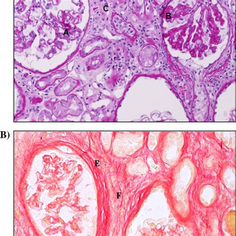 Kidney biopsy. A) PAS staining. Histology of the kidney with... | Download Scientific Diagram