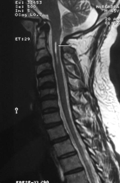 Unusual Association Of Arnold Chiari Malformation And Vitamin B12