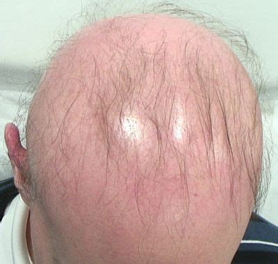 Alopecia Universal Diagnostico y Tratamiento Caída del