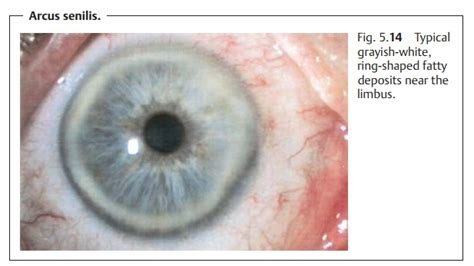 Corneal Deposits