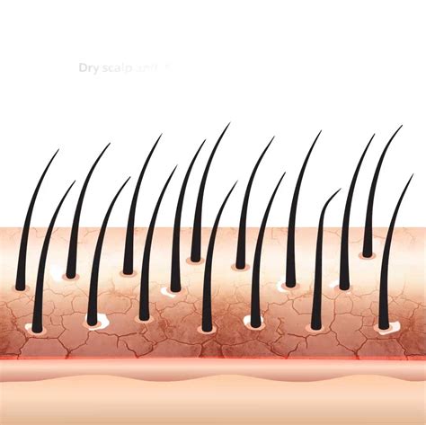 Dandruff Scalp Diagram