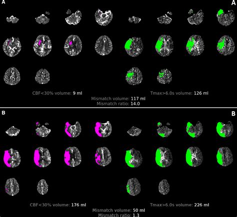 Review Of Perfusion Imaging In Acute Ischemic Stroke Stroke