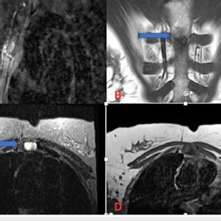 (A) Sagittal T1 fat-saturated post-contrast image of manubriosternal... | Download Scientific ...