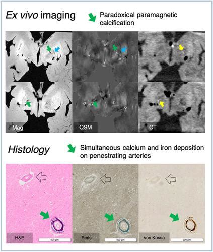 Paradoxical Paramagnetic Calcifications In The Globus Pallidus An Ex