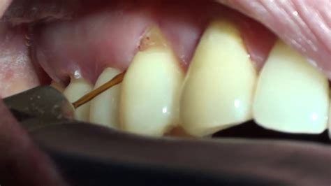 Subgingival Calculus Removal And Sulcular Debridement With Ercrysgg