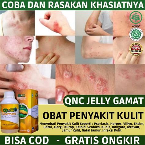 Obat Penyakit Kulit Psoriasis Herpes Viligo Eksim Gatal Alergi