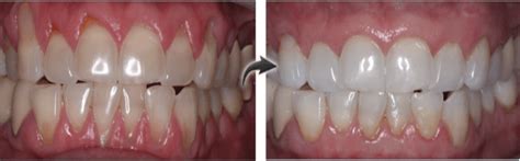 Pinhole Gum Surgery And Grafting In Nyc And Nj