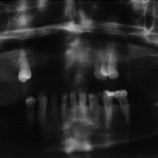 Ortopantomograf A Donde Se Muestran Los Procesos Estiloides Elongados