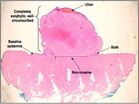 HistoQuarterly: PYOGENIC GRANULOMA | Histology Blog