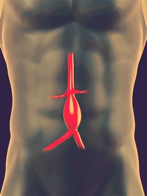 Aneurisma De Aorta Abdominal