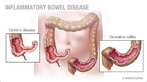 Crohns Disease