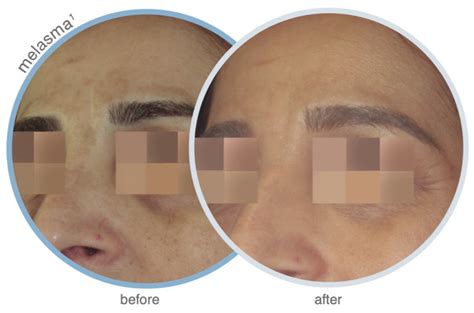 Cosmelan Md Peel Skinaesthetica