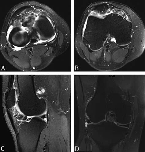A 37 Year Old Man With A Long Term Knee Mass Jbjs Image Quiz