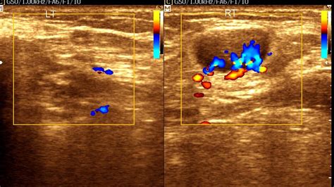 Ultrasound cases 272 of 2000 || Pleomorphic adenoma || Thyroid adenoma ...