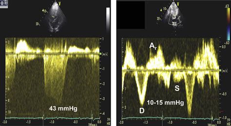 Tr Velocity 3 3 M Sec By Cw Doppler Left And Hepatic Venous Flow