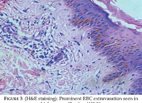 Figure From Phototherapy As An Effective Treatment For Majocchi S