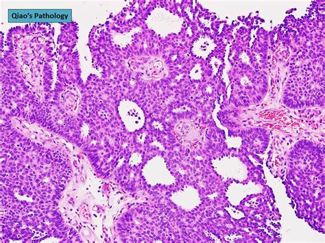 Qiaos Pathology Encapsulated Intracystic Papillary Carcinoma Of The Breast A Photo On