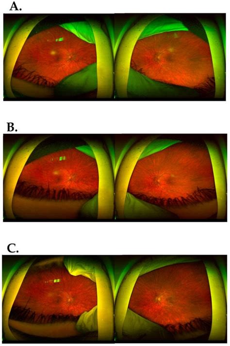 Jcm Free Full Text Isolated Depo Medrol Administration Under Tenon