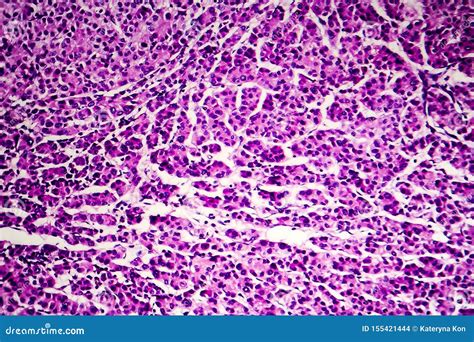 Hepatocellular Carcinoma Light Micrograph Stock Photo Image Of Micro