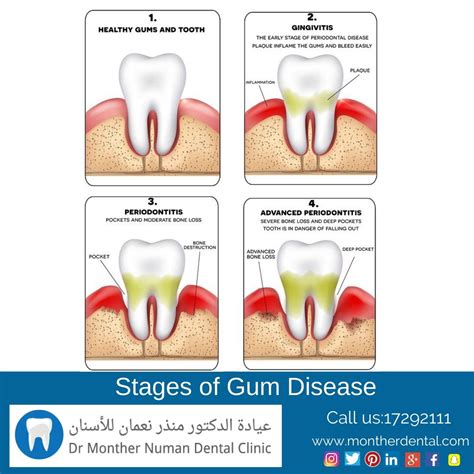 Stages Of Gum Disease Doctor Monther Numan Dental Clinic