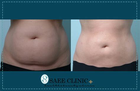 Slimming with lipolysis laser device - Saee Skin and Hair Clinic