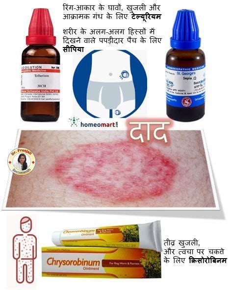 10 Best Natural Home Remedies For Ringworm Treatment Artofit