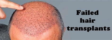 Why Some Hair Transplants Fail Best Practices To Avoid Failed Hair