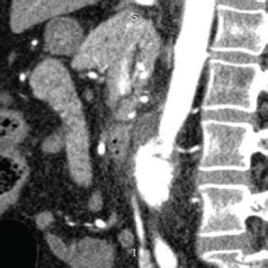 Multiplanar images demonstrating the infrarenal abdominal aorta. The... | Download Scientific ...