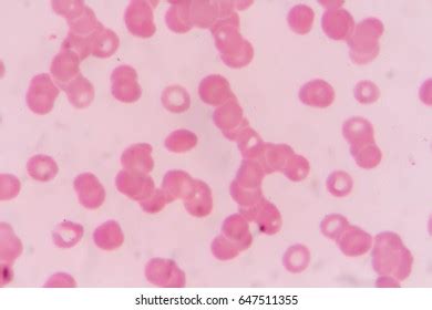 Rouleaux Formation On Blood Smear Stock Photo (Edit Now) 647511355