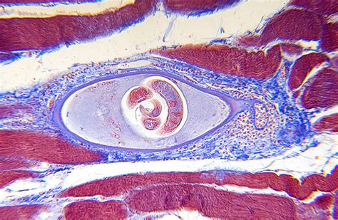 What is Trichinosis? — New Life Diagnostics