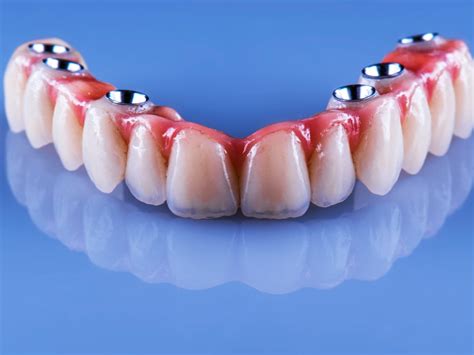 La Couronne Dentaire Sur Implant Centre Dentaire Pierrelaye