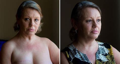 The Sun On Twitter Breast Cancer Survivor Left With Wonky Boobs