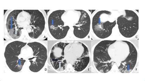 A Multiple Ground Glass Opacities And Consolidation With A Thickened Download Scientific