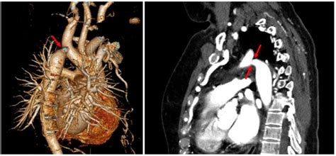 Computed Tomography Angiogram Of The Aorta Download Scientific Diagram