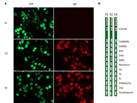 Figure 1 From Caveats And Pitfalls Of SOX1 Autoantibody Testing With A