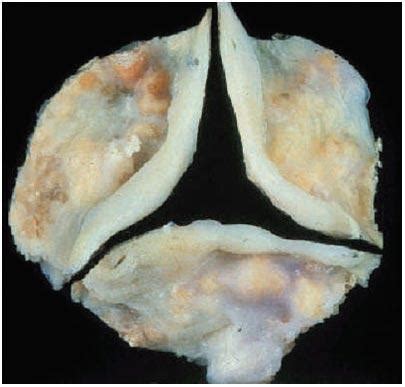 Calcified and Normal Heart Valves - Picture Comparison