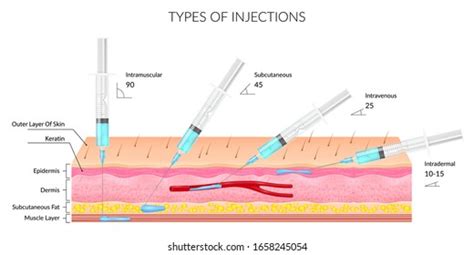 Subcutaneous Injection Sites For Injections