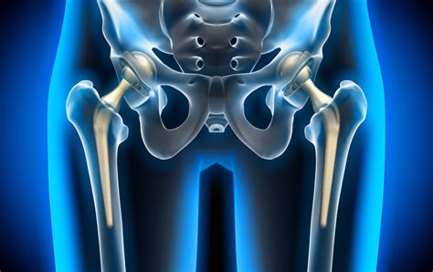 What To Know About Anterior Hip Replacement - Full Circle Orthopedics