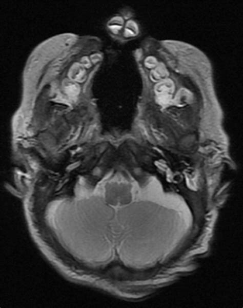 Radiology Of Cleft Lip And Palate Imaging For The Prenatal Period And