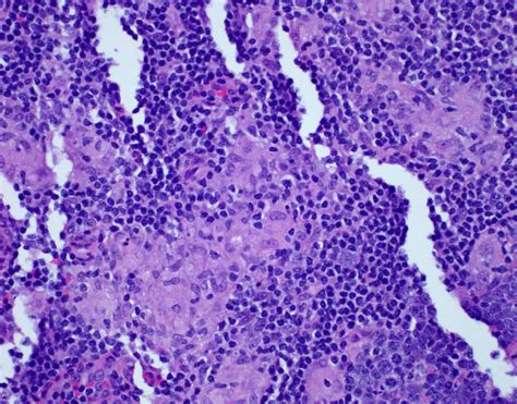 Pathology Outlines Toxoplasmosis