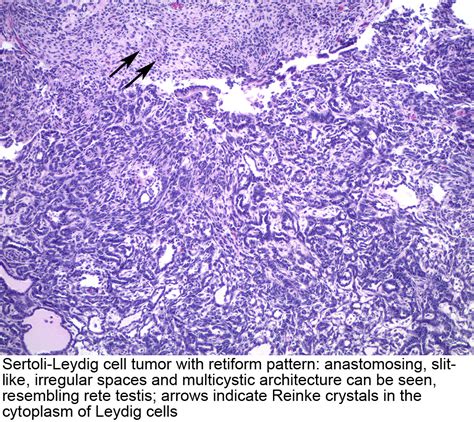 Pathology Outlines Sertoli Leydig Cell Tumor