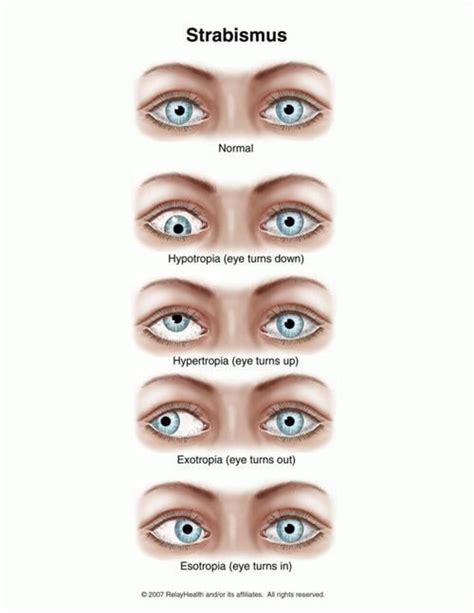 Strabismus Medizzy