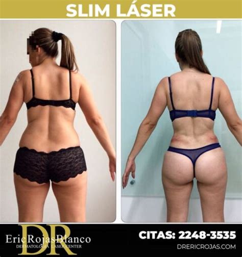 Cambios Incre Bles Con Slim L Ser Dr Eric Rojas Dermatolog A