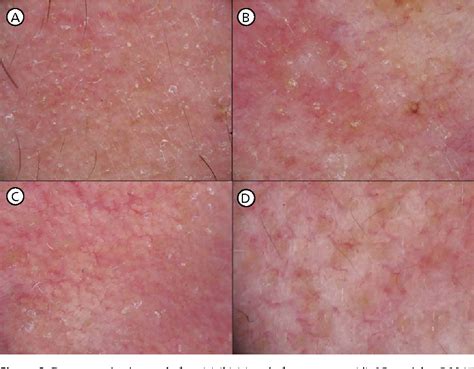 Figure 8 From Usefulness Of Dermoscopy In The Diagnosis And Monitoring