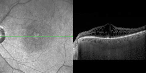 Cystoid Macular Edema Cme